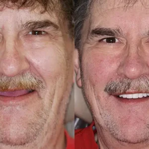 HZA™ Advanced Customized Full Denture Set
