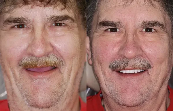 HZA™ Advanced Customized Full Denture Set