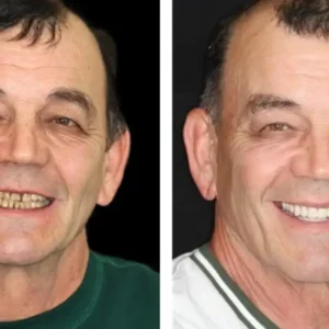 HZA™ Advanced Customized Full Denture Set
