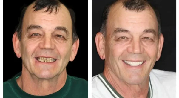 HZA™ Advanced Customized Full Denture Set