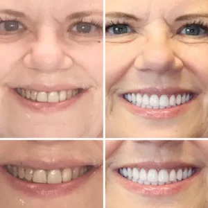 HZA™ Advanced Customized Full Denture Set