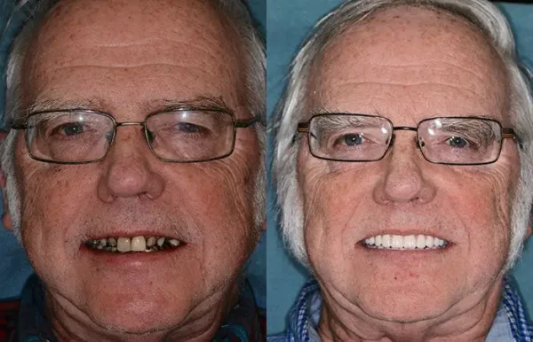 HZA™ Advanced Customized Full Denture Set