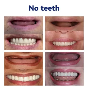 NESLEMY™ Advanced Customized Full Denture Set
