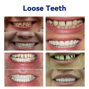 NESLEMY™ Advanced Customized Full Denture Set