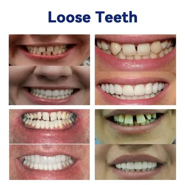 NESLEMY™ Advanced Customized Full Denture Set